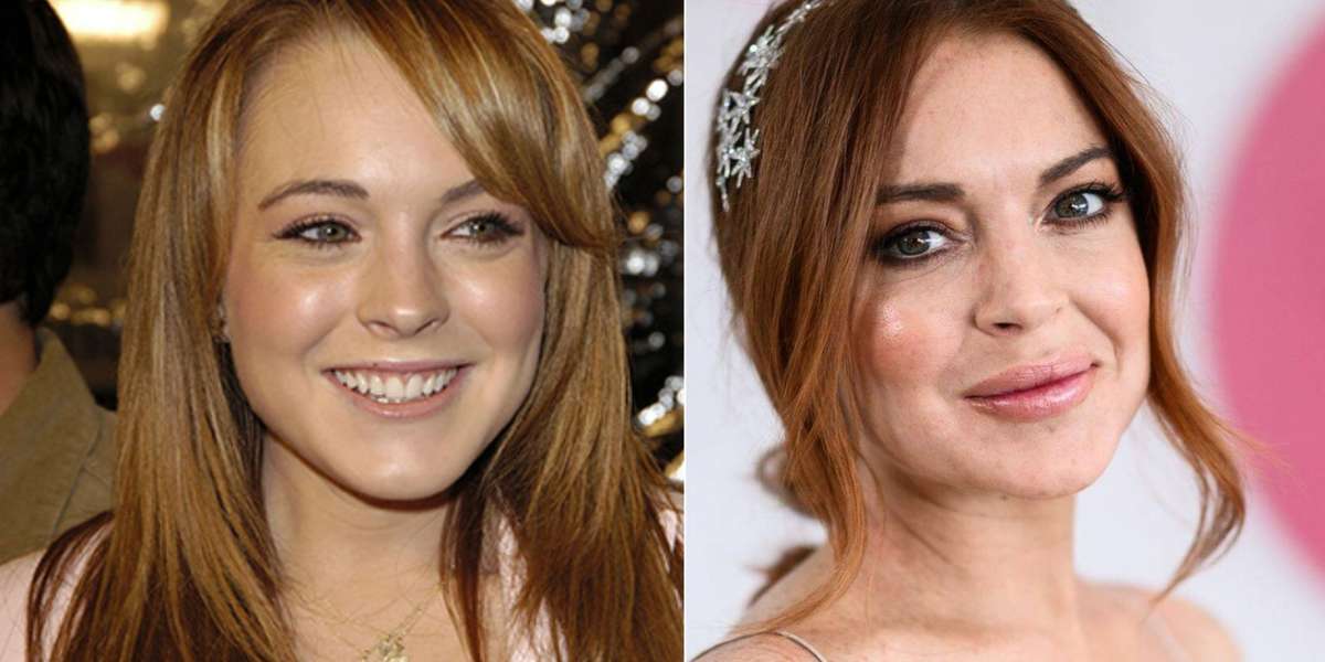 ¿Qué le pasó en la cara a Lindsay Lohan y por qué luce tan diferente?